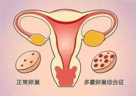 多囊卵巢综合征导致的不孕该如何诊治？要怎么调理才能好起来